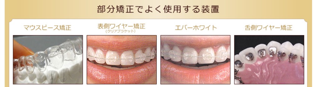 東京でも安く歯科矯正ができる 東京でなるべく安く歯科矯正をするには 部分矯正という選択